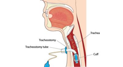 tracheostomy